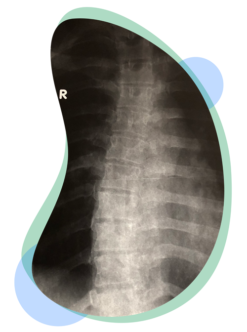 AIS is an irregular, sideways curvature in the spine.<br />
It has no known cause or cure.